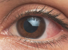 Eye Disorders NCLEX Topics