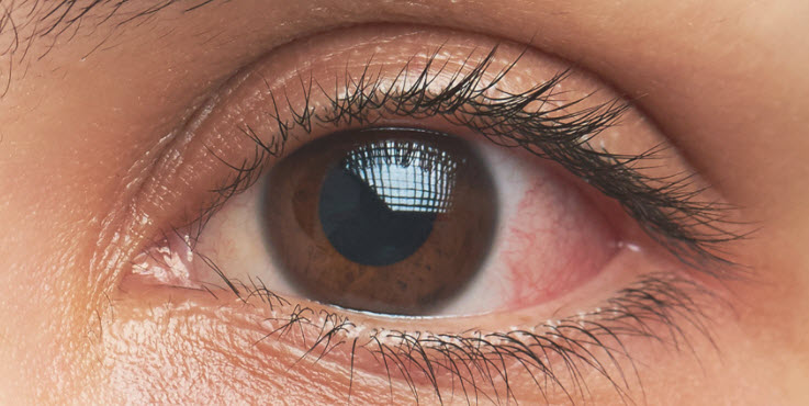 Eye Disorders NCLEX Topics